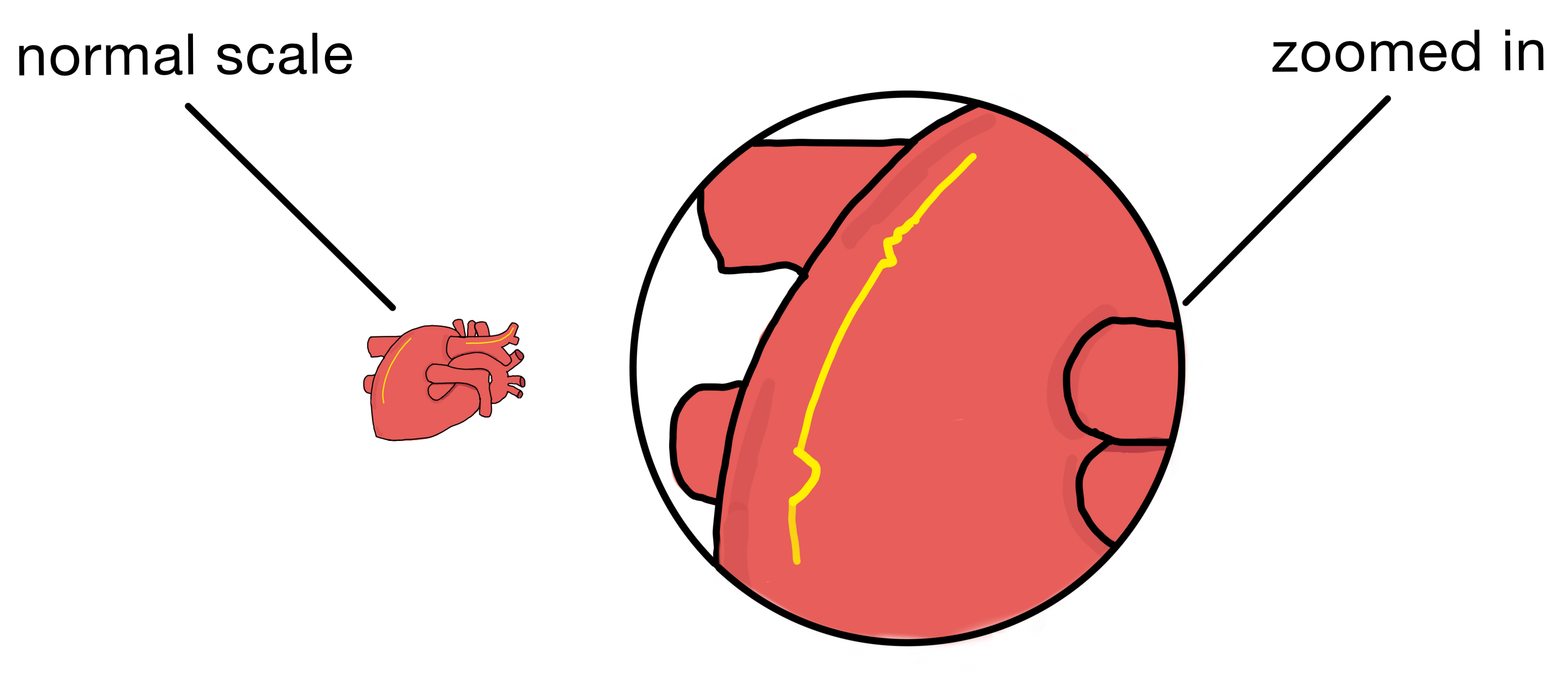 On the left, a standard-scale depiction of a noise-free trace (yellow) is shown. Meanwhile, the right side displays an enlarged view revealing noise within the trace on the heart.